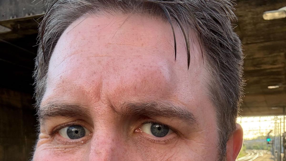 Tom Campbell with a lump on his forehead